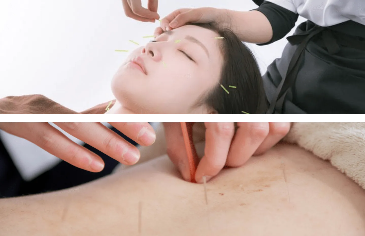 鍼灸施術の様子